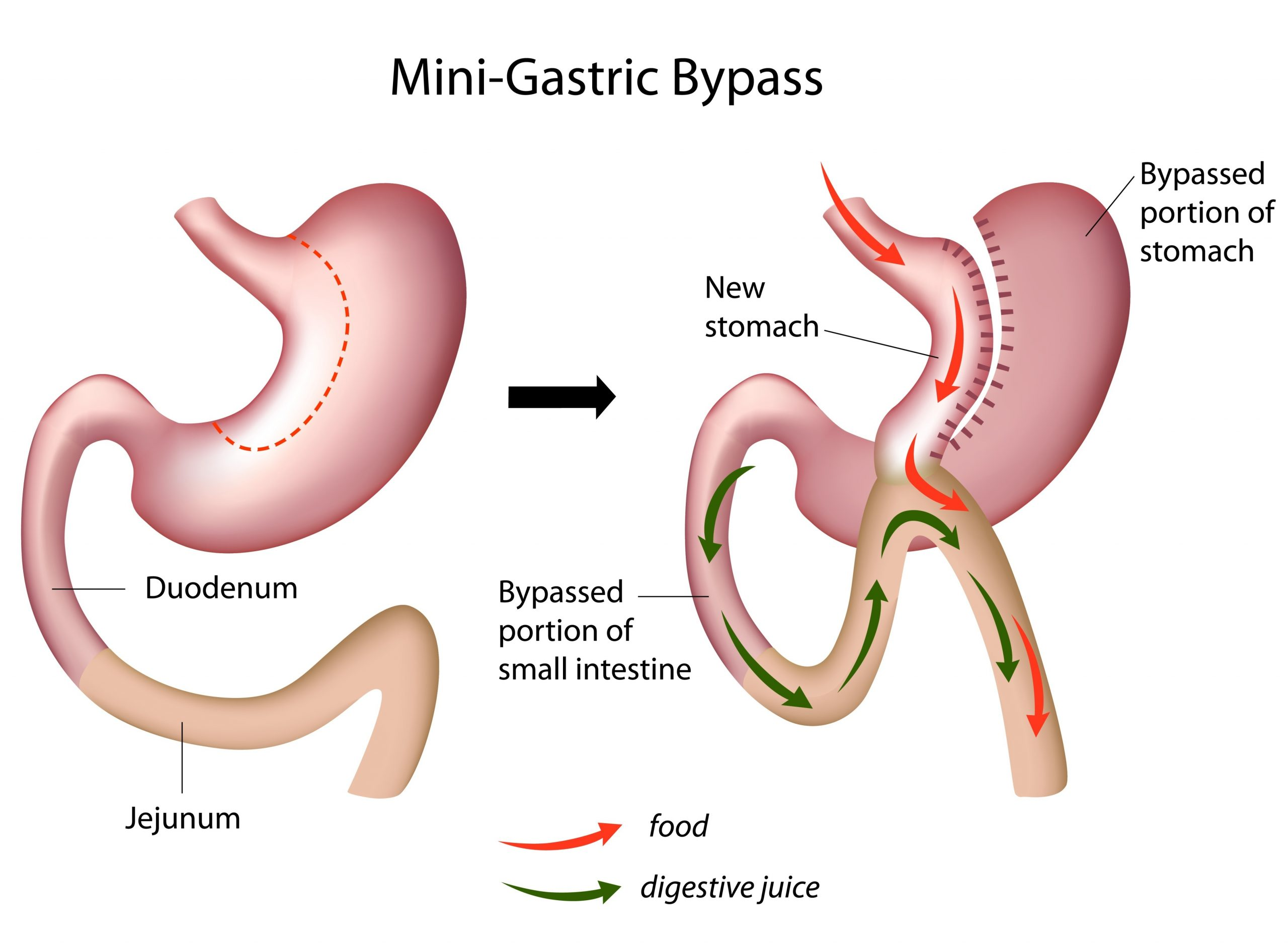 mini gastric bypass forum