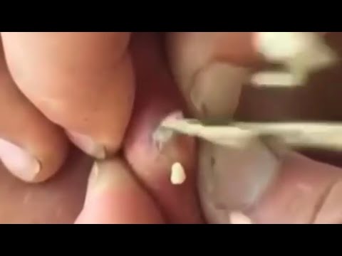 popping spots youtube