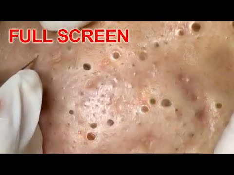 popping zits on youtube