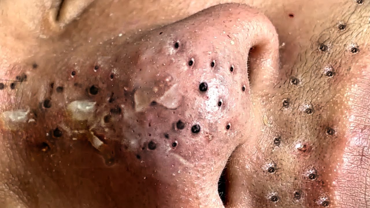 videos of blackhead removal